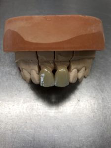 Emax Stratifiées