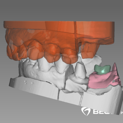 Jean-Paul_001_DentalCadScreenshot