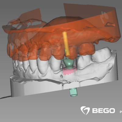 peyrucq_001_DentalCadScreenshot2