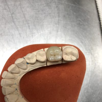 Chapes EMAX+stratifications
