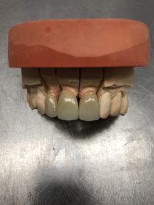 Emax Stratifiées