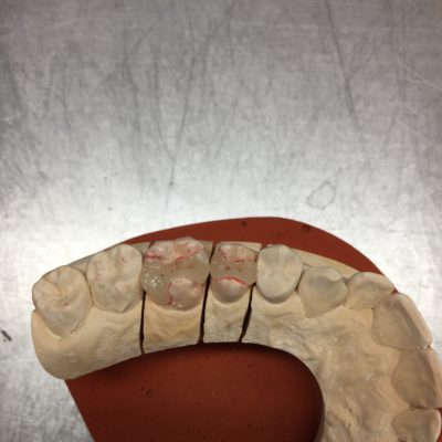 Chapes EMAX+stratifications