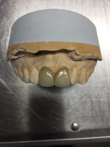 Facettes Emax Stratifiées